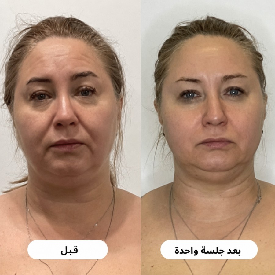 قبل وبعد لتخفيف مظهر الخطوط والتوتر